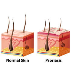 human-skin-diagram-with-normal-and-psoriasis-vector-14709870.jpg