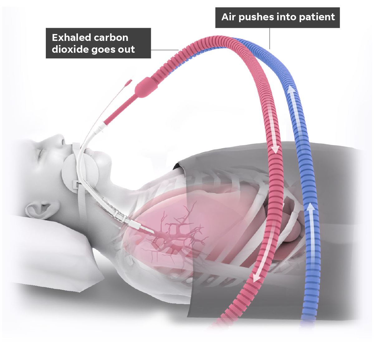 55bbf052-3ec3-4005-9d59-902ea75e9564-Art_intubation3.png