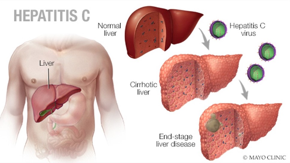 hepatitis_c.jpg