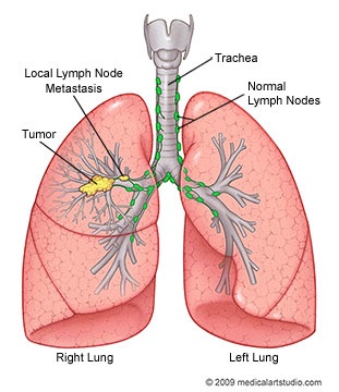lung-cancer-diagram-lung-tumor.jpg