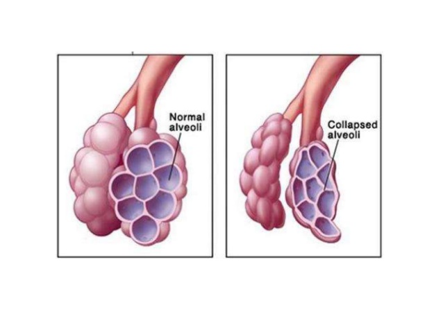 neonatal-respiratory-distress-syndrome-7-638.jpg