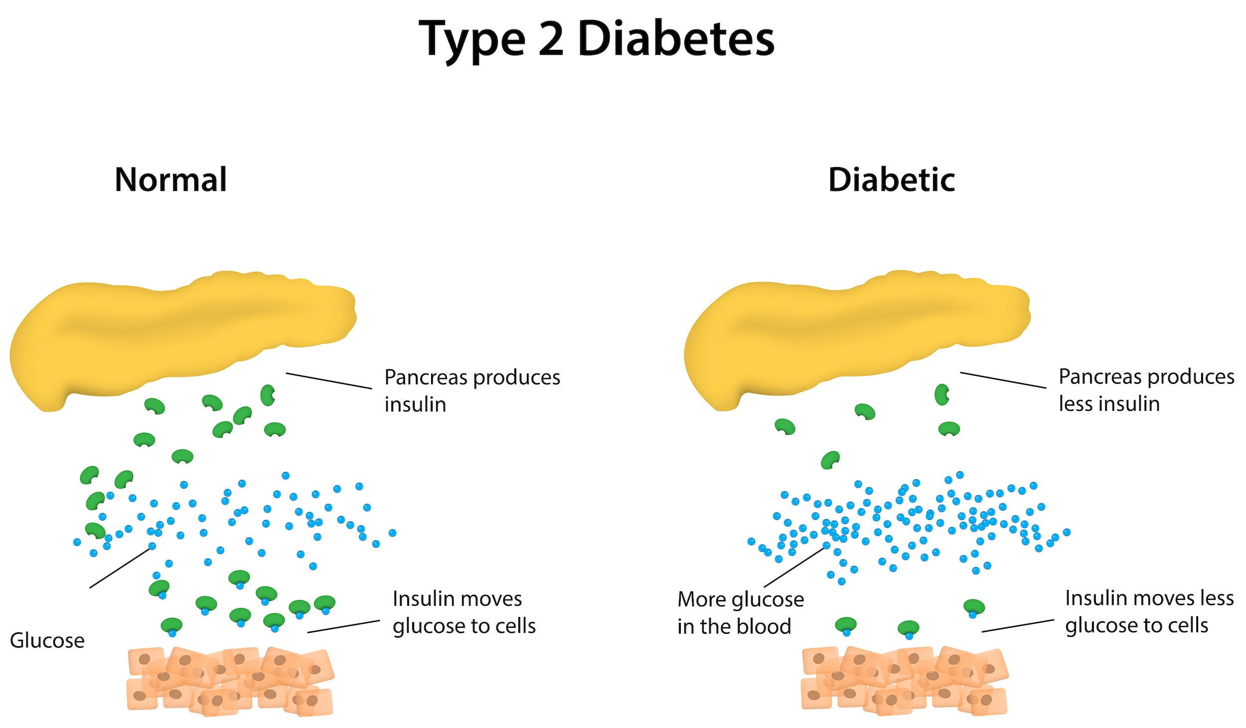 in_type_2_diabetes__the_pancreas_produces_less_insulin_which_results_in_less_glucose_moving_from_the_blood_stream_into_the_c.jpg