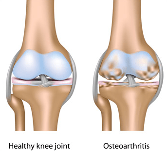 healthy-knee-vs-osteoarthritis.png