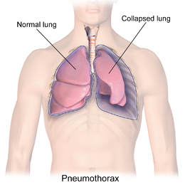 Blausen_0742_Pneumothorax.png