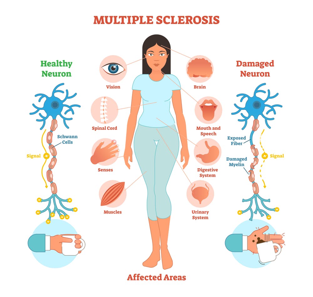 multiple-sclerosis-wecapable.jpg