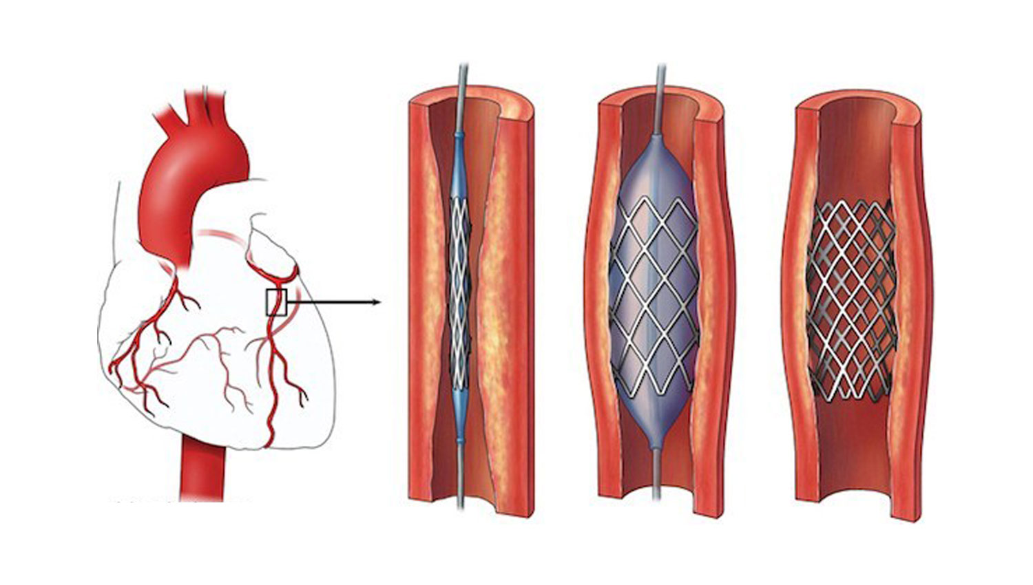 angioplasti-pasang-ring-sakit-jantung.jpg