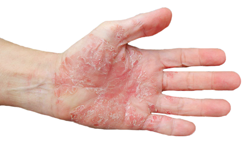 psoriasis-harpmed-psoriasis-png-796_468.png