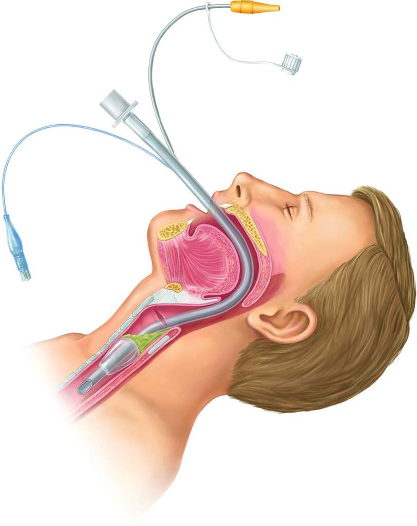 endotracheal-intubation.jpg