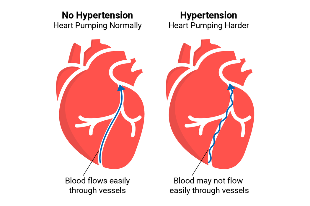 Hypertension Illustration.png