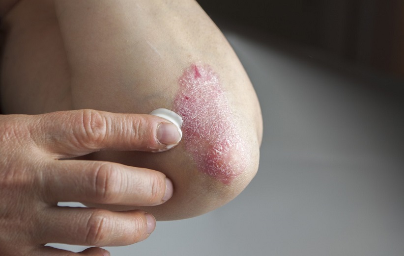 Psoriasis-7.jpg