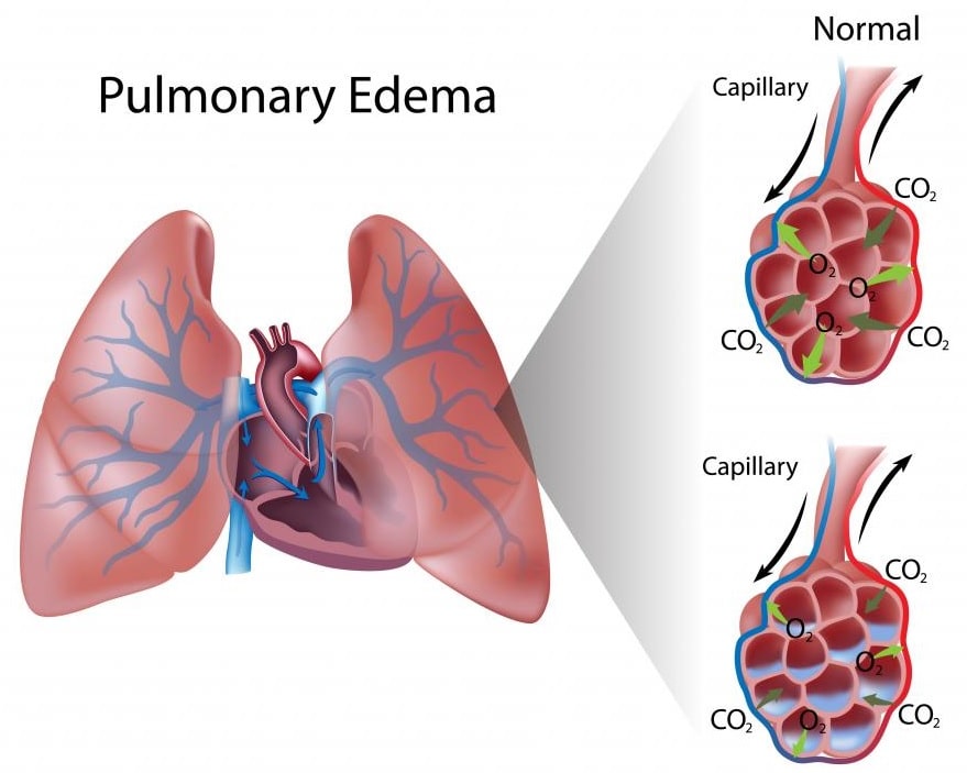 edema-min.jpg