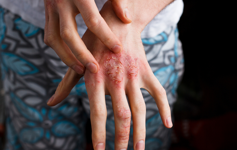 Psoriasis-1.png