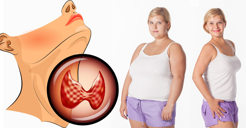 hypothyroid-weight-loss-FI.jpg