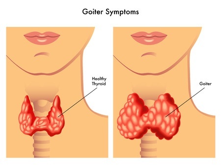 goiter32558857_s.jpg