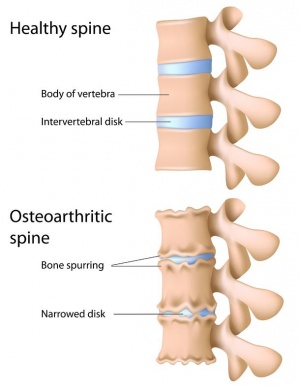 osteoarthritis_spine11122409_M.jpg