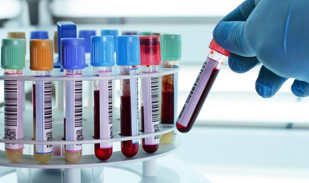 Laboratory-blood-samples-shutterstock_143897611-35s9p1am7tcxrhf0gptczk.jpg