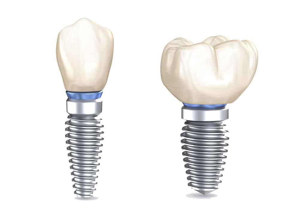 dental-implants-3d-illustration-of-human-teeth.jpg