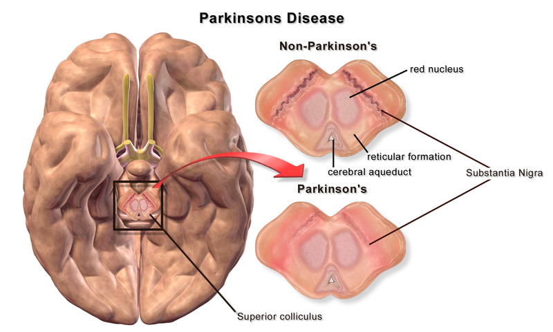 Difference-Between-MS-and-Parkinson’s-1.png