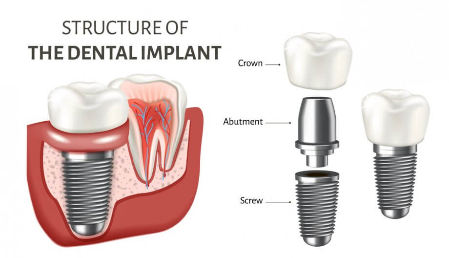 dental-implant-and-crown-920x528.jpg