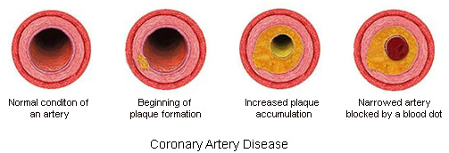 Coronay-Artery-Disease1.jpg