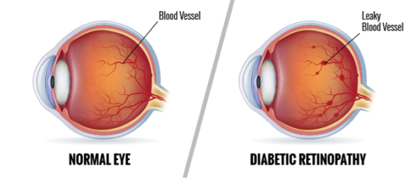 Diabetic-Retinopathy-600x257.png