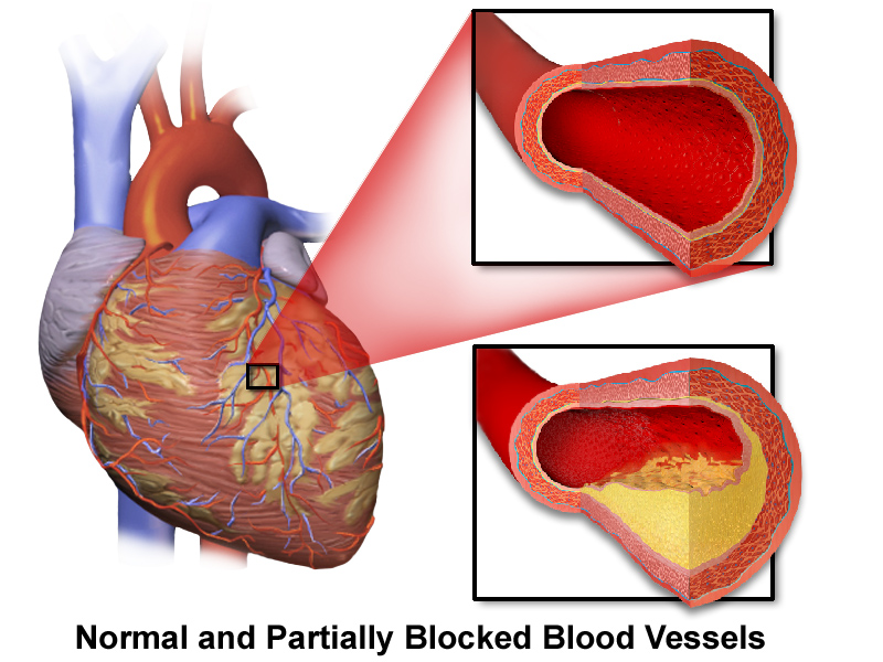 Coronary_Artery_Disease.png