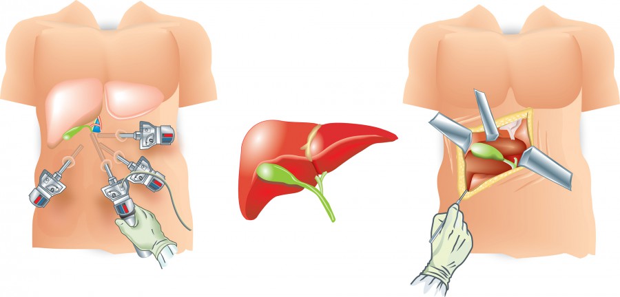 577-laparoscopy-vs-open-surgery_full.jpg