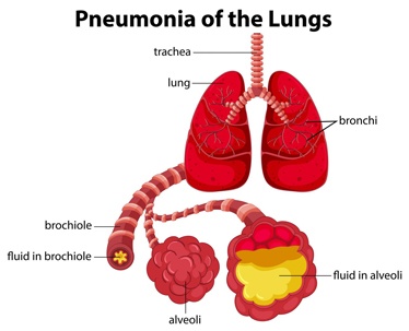 Pneumonia-of-the-lungs.jpg