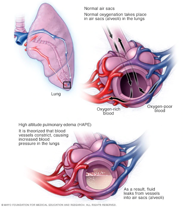 mcdc7_high-altitude-pulmonary-edema.webp