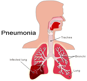 lungs-infected-with-pneumonia.png