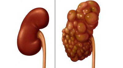 نارسایی-کلیه2.jpg