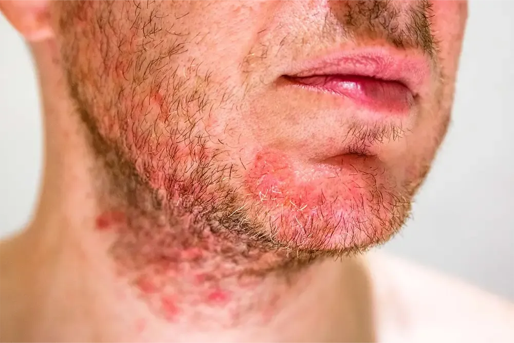 درماتیت صورت چیست و چگونه درمان می‌شود؟